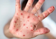 Protocolos epidemiológicos fueron activados por caso de sarampión en Imbabura