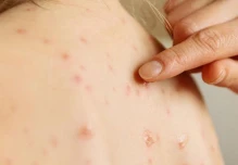 Ecuador intensifica vigilancia epidemiológica por el sarampión