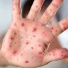 Protocolos epidemiológicos fueron activados por caso de sarampión en Imbabura