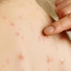 Ecuador intensifica vigilancia epidemiológica por el sarampión
