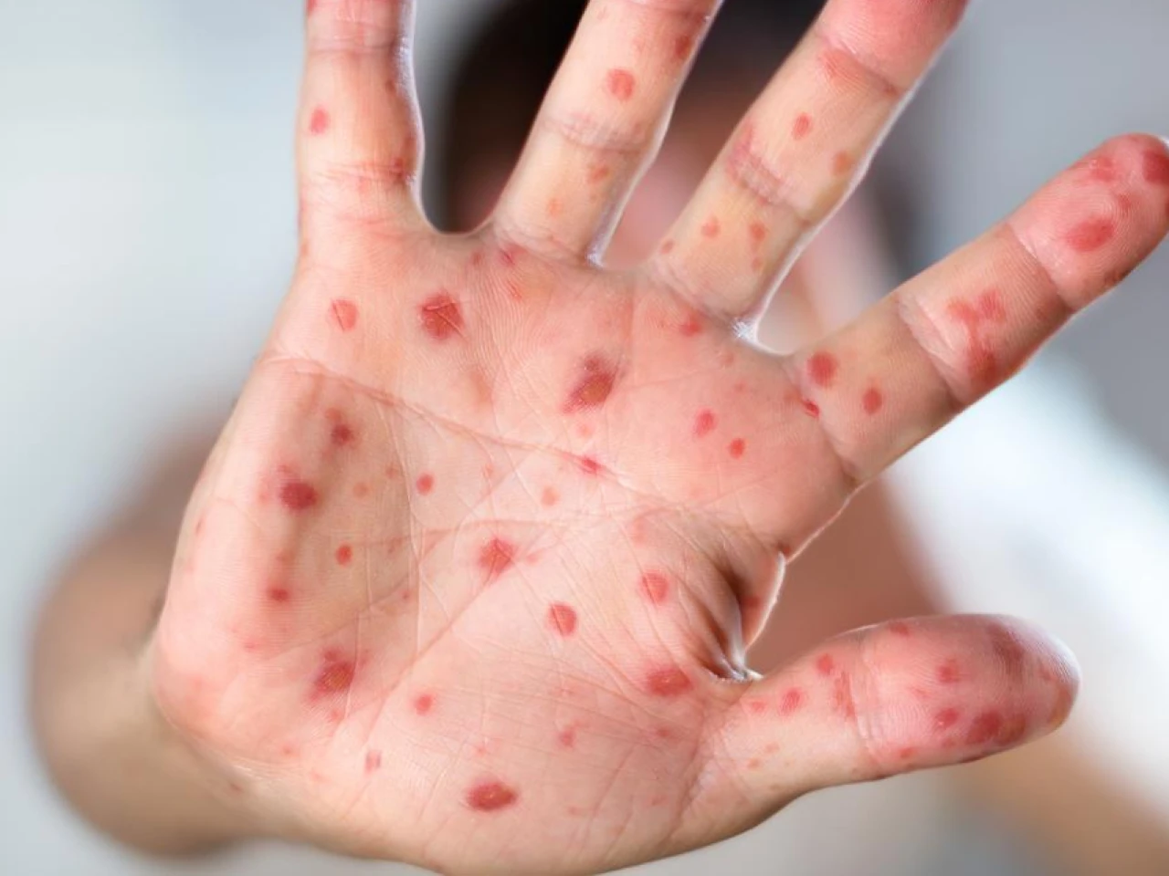 Protocolos epidemiológicos fueron activados por caso de sarampión en Imbabura