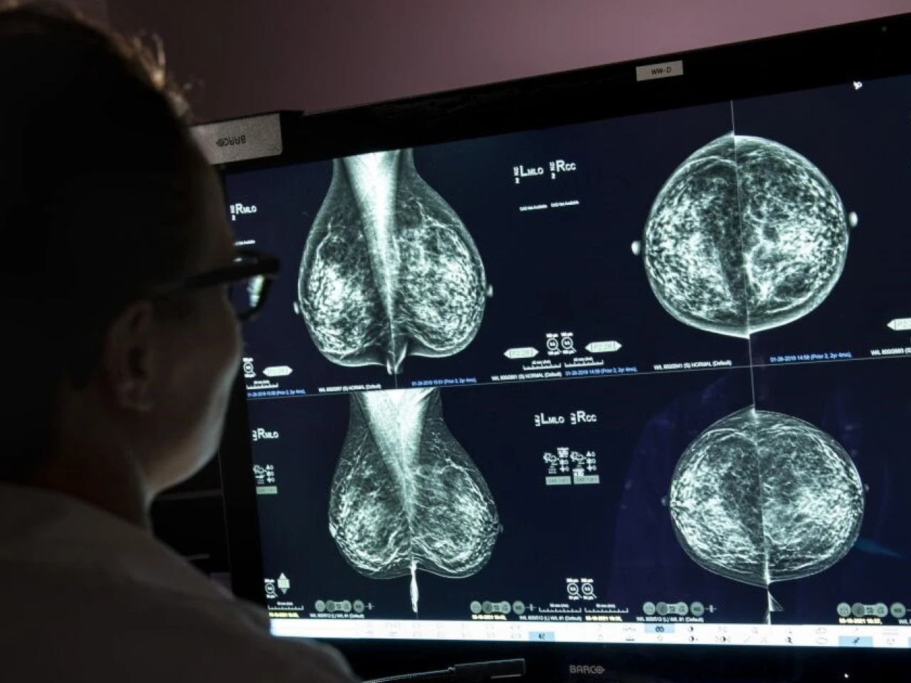 La Inteligencia Artificial, una herramienta contra el cáncer de seno