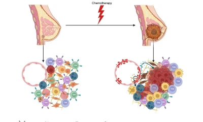 Un fármaco estándar utilizado en la quimioterapia lesiona las células circundantes no cancerosas, lo que puede "despertar" a las que están latentes / Foto: cortesía EFE