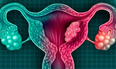 Esta enfermedad se relaciona con el Virus del Papiloma Humano (VPH), el cual es transmitido sexualmente/ Foto: Cortesía