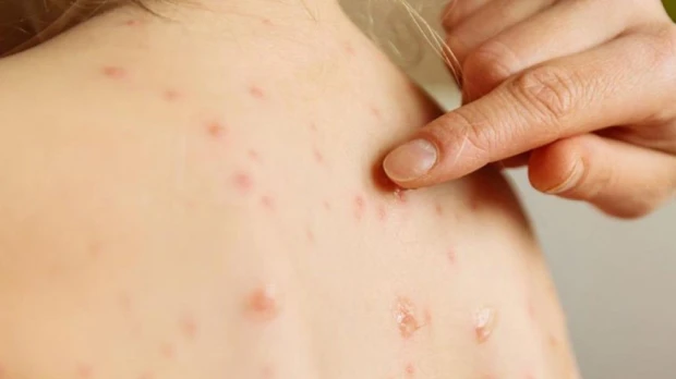 Ecuador intensifica vigilancia epidemiológica por el sarampión