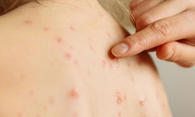 Según la OMS, hasta junio de 2025, se han reportado más de 88.000 casos confirmados de sarampión en el mundo / Foto: cortesía